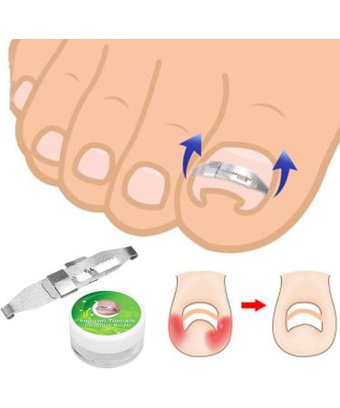Ingrown Toenail Treatment Stainless Steel Ingrown Toenail Corrector Relief Paronychia Treatment Correcting Tool - Buy Online on SooperMarket.com