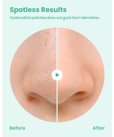 GLAM UP Spotless Nose Patch XL - Hydrocolloid Treatment for Pores, Pimples & Blackheads - 12 Patches - Buy Online on SooperMarket.com