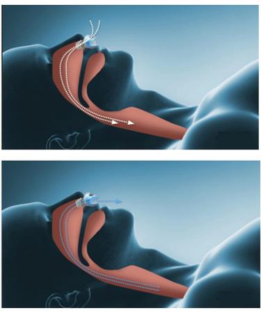 Yosoo Portable Electric Anti Snoring Device for Heavy Snorers - Blue - Buy Online on SooperMarket.com