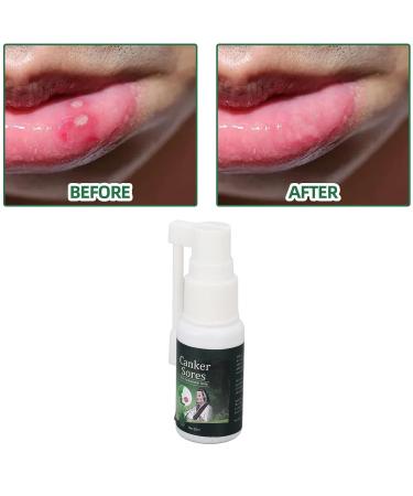 Mundspray - Ultimate Oral Ulcer Relief Bad Breath Reduction Dry Mouth Treatment & Gum Protection | Shop Now! - Buy Online on SooperMarket.com