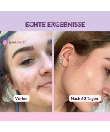 TOTES SEA Mask 250g | Vegan Anti-Acne Dead Sea Mud Mask for Men & Women | Natural Facial Mask for Clear Skin | Clay & Avocado | Best for Pimples & Blackheads - Buy Online on SooperMarket.com