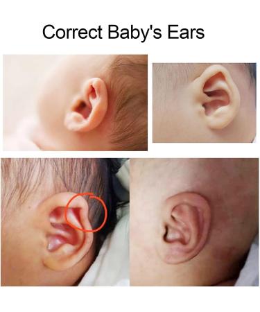Silicone Baby Ear Corrections 1 Roll 50 X 4 Cm Baby Auricle Valgus Correction Plasters Correction Infant Ear Against Remaining Ears - Buy Online on SooperMarket.com