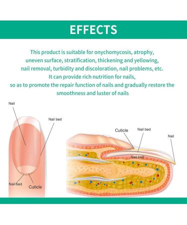 Nail Fungus Removal Liquid - Natural Toenail Fungus Oil for Effective Nail Care | BTSEURY - Buy Online on SooperMarket.com