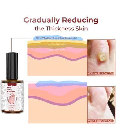 Xebular Foot Corn Removal Gel - Extra Strength Liquid for Toes - Callus & Corn Remover (3 PCS) - Buy Online on SooperMarket.com