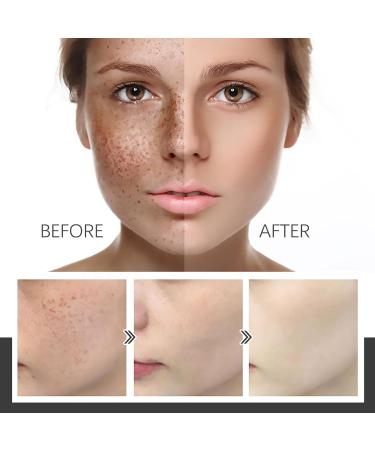 Dark Spot Remover for Face Hyaluronic Acid Dark Spot Correcting Serum Anti Aging Face Serum for Women Nicotinamide Dark Spot Correcting Glow Serum Anti Spot Face Serum and Oil Skin Moisturizer-30ml - Buy Online on SooperMarket.com