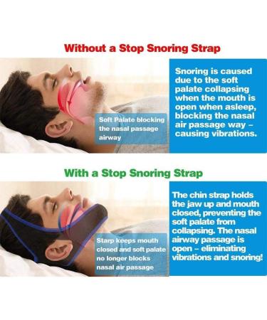 KETINAU Snoring Chin Strap - Adjustable Snore Device for Men and Women - Blue - Buy Online on SooperMarket.com