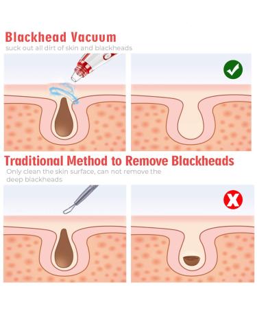 2023 Blackhead Remover Pore Vacuum - Upgraded Electric Facial Cleaner with 5 Suction Power Probes - USB Rechargeable Blackhead Vacuum Kit for Women & Men - Buy Online on SooperMarket.com