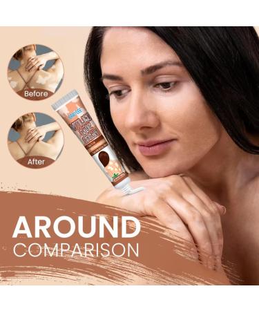 Natural Vitiligo Cream - Effective Treatment to Reduce White Spots & Improve Skin Pigmentation | International Shipping - Buy Online on SooperMarket.com