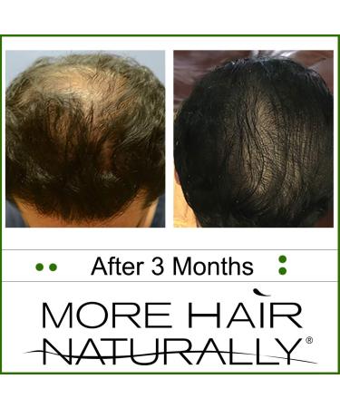 More Hair Naturally 9 - Advanced Stem Cell Therapy for Thinning Hair - Buy Online on SooperMarket.com