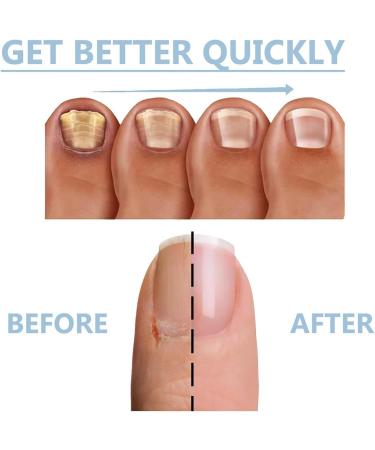 Nail Growth and Repair Serum Nail Strengthening and Growth Conditioner Nourish Strengthen And Revitalize Your Nails (1 Pcs) - Buy Online on SooperMarket.com