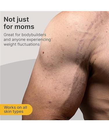 Stretch Marks Removal Cream | Safe for Pregnancy | Dermatologically Tested | All Skin Types | 100g - Buy Online on SooperMarket.com