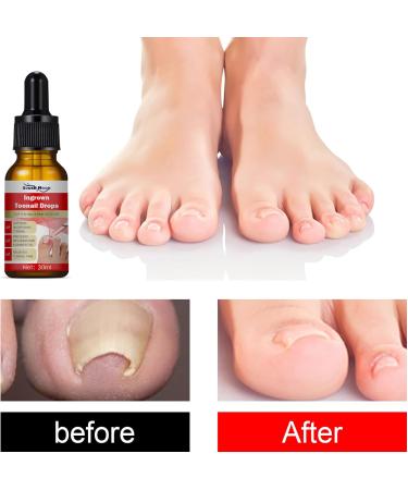 Ingrown Toenail Treatment - 30ml Ingrown Toenail - Cuticle Care Oils for Ingrown Toenails - Trimming Toenail Softening Drops Natural Ingrown Toenail Correction Treatment Fungal Nail Treatment - Buy Online on SooperMarket.com