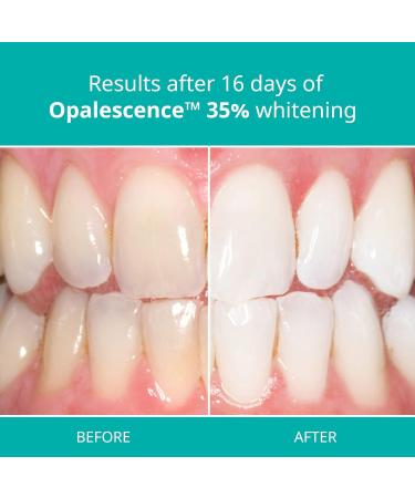 Opalescence 35% Teeth Whitening Gel Syringes - 4 Pack Mint Flavor - Buy Online on SooperMarket.com