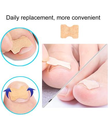 Ingrown Toenail Correction Foot Care Pedicure Sticker Corrector Ingrown Patch Relief Toe Patch Treatment Tool60pcs (60 Pieces) - Buy Online on SooperMarket.com
