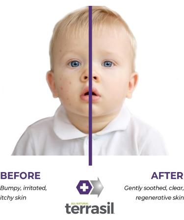 Terrasil Molluscum Contagiosum Ointment for Symptom Relief - All-Natural Skincare Solution for Inflammation and Itch - Safe for Children - 45g - Buy Online on SooperMarket.com