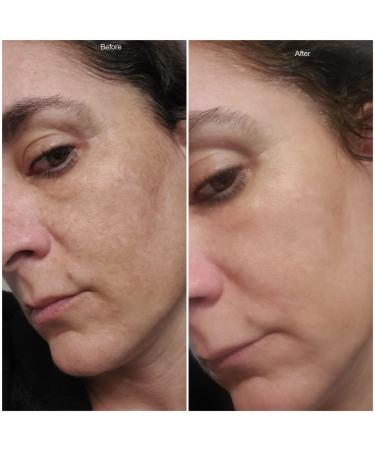Dark Spot Corrector & Brightening Serum with Kojic Acid, Vitamin C, Salicylic Acid & More | Melasma Treatment Cream by Admire My Skin - Buy Online on SooperMarket.com