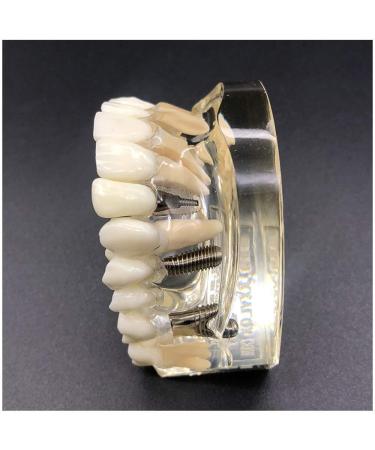 Implant Tooth Template | Oral Simulation Dental Study Model for Teaching - Shop Internationally - Buy Online on SooperMarket.com
