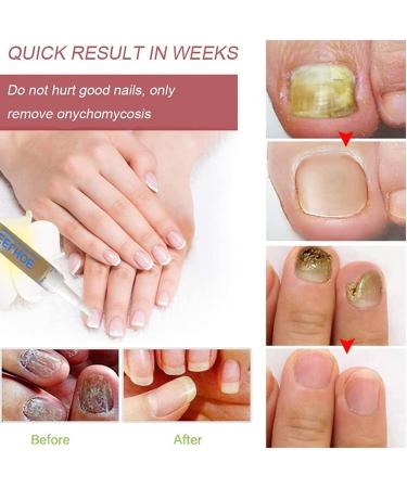 Okita Toenail Fungus Treatment Pen - Effective Nail Repair for Healthy and Strong Nails (5Pcs) - Buy Online on SooperMarket.com
