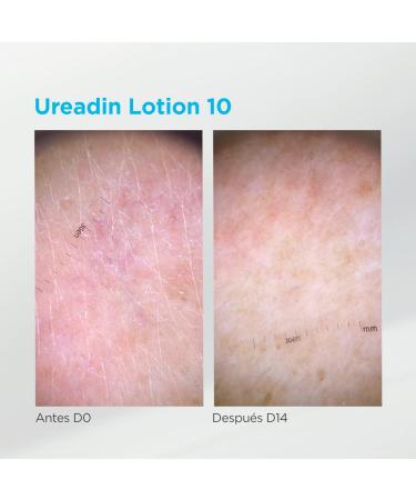 ISDIN Ureadin Lotion 10 (1000ml) Intensive Moisturizing Body Lotion for Dry Skin with 10% Urea | 1 Liter Pack - International Shipping Available - Buy Online on SooperMarket.com