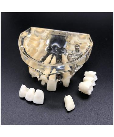 Implant Tooth Template | Oral Simulation Dental Study Model for Teaching - Shop Internationally - Buy Online on SooperMarket.com