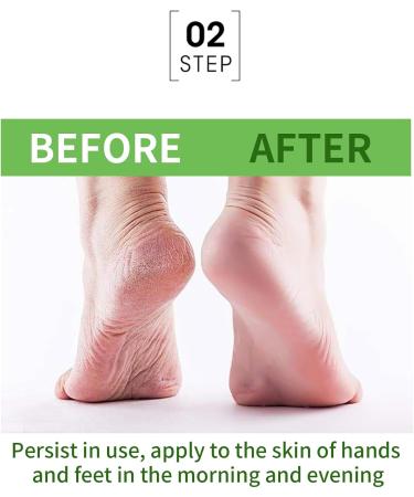 42% Urea Foot Cream - Urea Cream for Feet - Foot Cream for Dry Cracked Heels and Feet - Urea Cream with Salicylic Acid 2% Tea Tree Aloe Vera - Foot Lotion for Deep Moisturize for Thick Rough Skin - Buy Online on SooperMarket.com