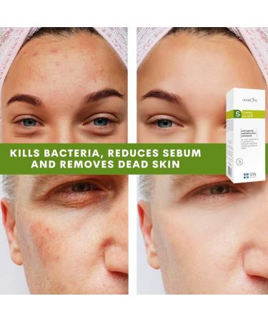 DermoTIS Sulphur 7% Cream for Oily Acne Seborrheic Skin Care Removes Skin Seborrheic Scales Exfoliating Properties Face and Body Unisex - Buy Online on SooperMarket.com
