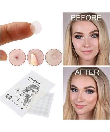 36 Acne Pimple Spot Zit Patches Face Treatment Stickers Pimple Cover Invisible Hydrocolloid Absorbing Cover Up Covering Healing Patch for Concealer Blemish Care + Free Blackhead Zit Remover Tool - Buy Online on SooperMarket.com