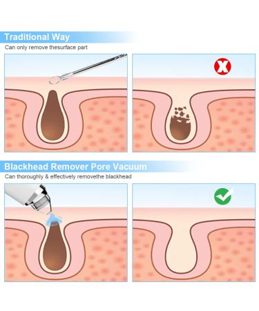 Silkwish Electric Blackhead Remover Pore Vacuum with HD Camera - USB Rechargeable Kit for Women & Men - Buy Online on SooperMarket.com