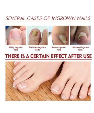 2PCS German Toenailplus Anti Paronychia Relief Oil - Nail Repair for Damaged Thick Nails - Buy Online on SooperMarket.com