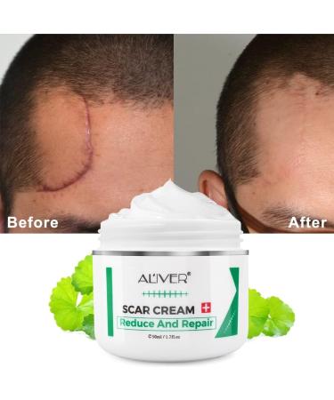Scar Repair Cream | Acne Scar Removal & Pigmentation Corrector | Stretch Mark Remover | Skin Whitening | Scar Care - Buy Online on SooperMarket.com