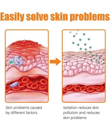 LONGLUAN Youth Bee Venom Anti-Itch Psoriasis Treatment Cream - 2Pcs Set | Soothing & Moisturizing Formula for All Skin Types - Buy Online on SooperMarket.com