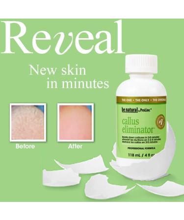 ProLinc Fast Acting Callus Eliminator 4 Fl Oz - Effective Callus Removal Treatment - Buy Online on SooperMarket.com