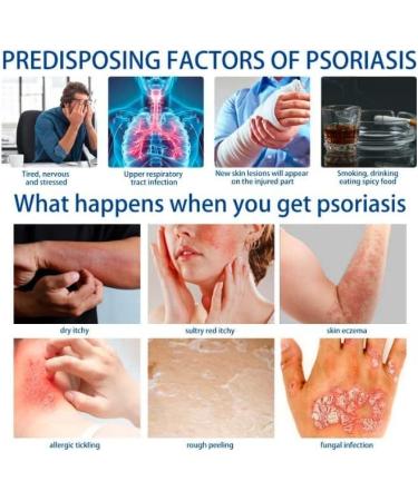 Eczema & Psoriasis Cream - Natural Relief for Dry, Itchy Skin | Scalp Rash Redness Acne - Buy Online on SooperMarket.com