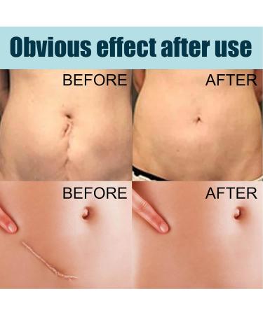 Stretch Marks & Scar Gel 50ml - Safe Vitamin E Formula for Effective Removal - Buy Online on SooperMarket.com