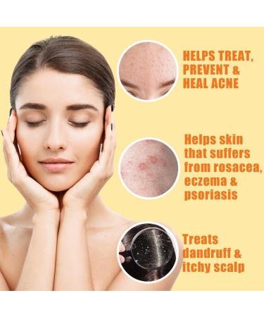 10% Sulfur Soap Cleansing Bar for Acne & Oily Skin - Natural Face & Body Cleanser with Lemongrass, Tea Tree Oil, Vitamin E & Coconut Milk - Made in USA - Buy Online on SooperMarket.com