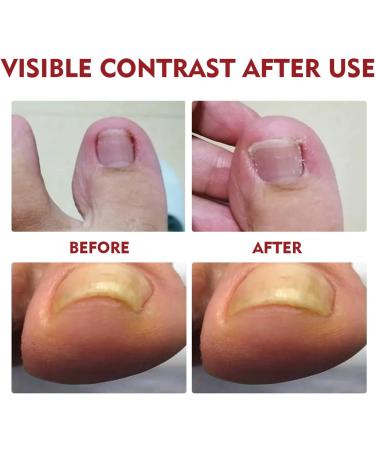Toenailplus Anti Paronychia Relief Oil - 10ml 2pcs - Nail Helper for Ingrowth Toenail Correction & Paronychia Treatment - Buy Online on SooperMarket.com