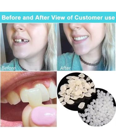 Fake Tooth Repair Kits for Filling The Missing Broken Tooth and Gaps-Moldable Fake Teeth and Thermal Beads Replacement Kits - Buy Online on SooperMarket.com