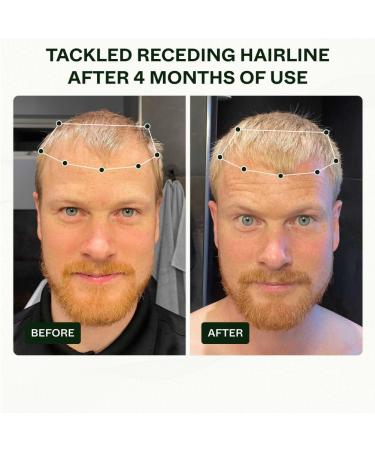 Scandinavian Biolabs Hair Growth System for Men | Clinically Proven Hair Loss Treatment in 45 Days - Buy Online on SooperMarket.com