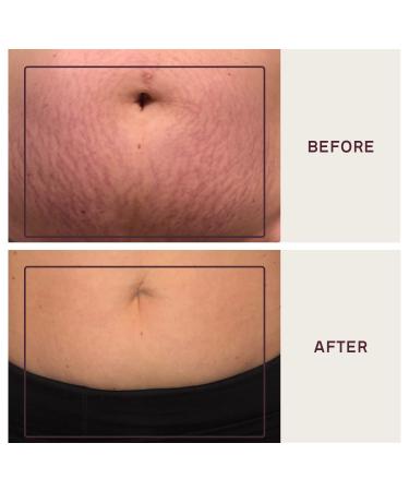 Dermaclara Silicone Stretch Marks Patch Kit | Scar Treatment Gel | Pregnancy Safe Skincare | Postpartum Care | Skin Firming Formula | Baby Shower Gift | Natural Stretch Mark Oil | 2x 7in Patches + Patch Prep - Buy Online on SooperMarket.com