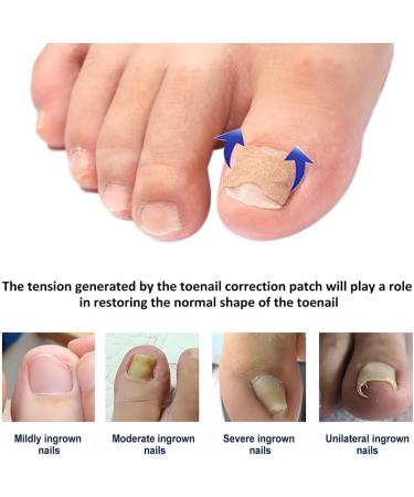 Toenail Patch Ingrown Toenail Toenail Correction Toenail Correction Patch Toenail Correction Patch Ingrown Toenail Nail Care 50 Pieces - Buy Online on SooperMarket.com