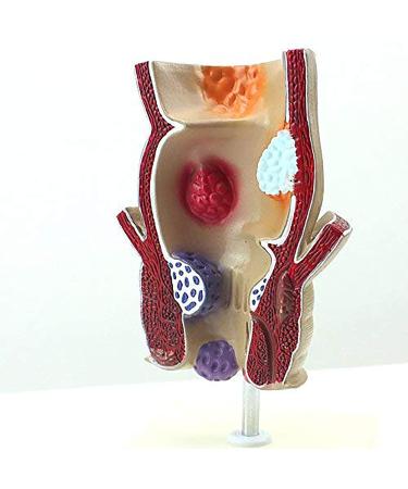 ZCBYBT Hemorrhoid Injury Model Human Rectal Pathology Model Internal and External Hemorrhoids Model Anus Model Suitable for Educational Use