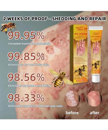 RJDJ Bee Venom Psoriasis Treatment Cream - Professional New Zealand Formula for All Skin Types (5PC) - Buy Online on SooperMarket.com