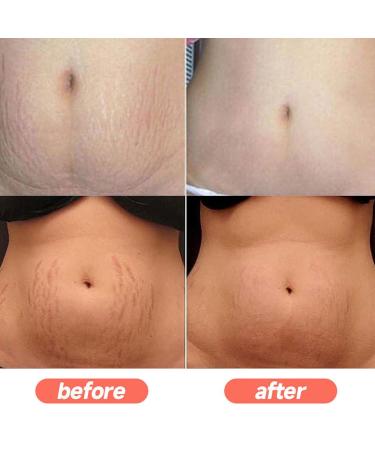 Best Stretch Mark Cream for Pregnancy | Tummy Butter & Belly Butter for Prevention & Repair - Buy Online on SooperMarket.com