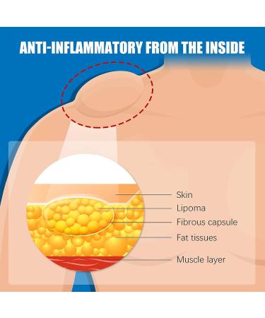 Lipoma Removal Cream 20g - Natural Treatment for Lipoma Care & Discomfort - Buy Online on SooperMarket.com