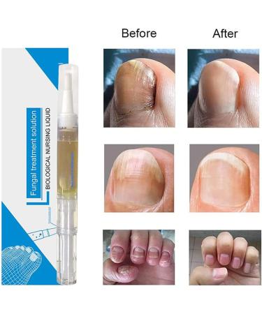 Okita Toenail Fungus Treatment Pen - Effective Nail Repair for Healthy and Strong Nails (5Pcs) - Buy Online on SooperMarket.com