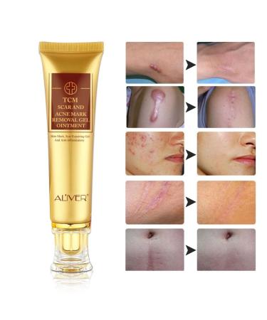 3 Pack TCM Scar Removal Cream - Scar Reducing Treatment for Stretch Marks, Acne Scars, Surgical Scars - 1.1 Ounce (Pack of 3) - Buy Online on SooperMarket.com