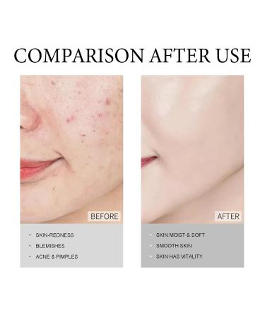 14% Azelaic Acid Cream | Premium Redness Relief Serum for All Skin Types | Niacinamide & Vitamin C | 1 Oz - Buy Online on SooperMarket.com