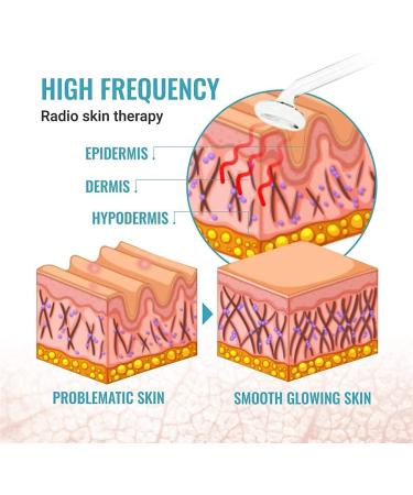 GES Supernova Darsonval Device - High Frequency Acne Treatment Hair Loss Solution & Anti-Aging Skin Care System for a Flawless Complexion - Buy Online on SooperMarket.com