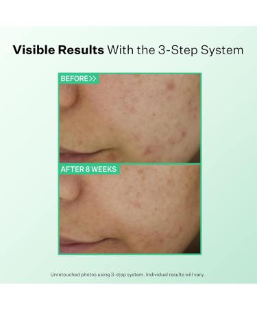 StriVectin Multi Action Clear Acne Treatment Set | 30-Day Trial Kit for Clearer Smoother Skin | Blemish Control & Breakout Defense - Buy Online on SooperMarket.com