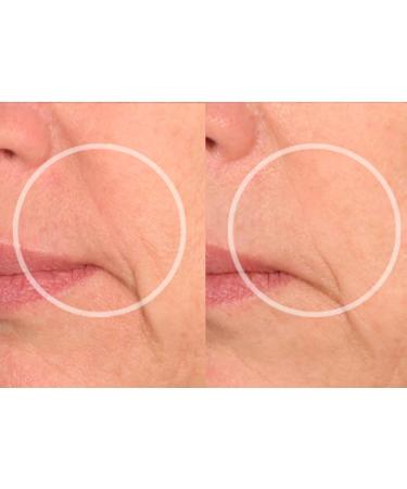 SiO LipLift Beauty Patches - Overnight Wrinkle Reducer for Lips & Smile | Clinically Tested Reusable 4-Week Supply - Shop Now - Buy Online on SooperMarket.com